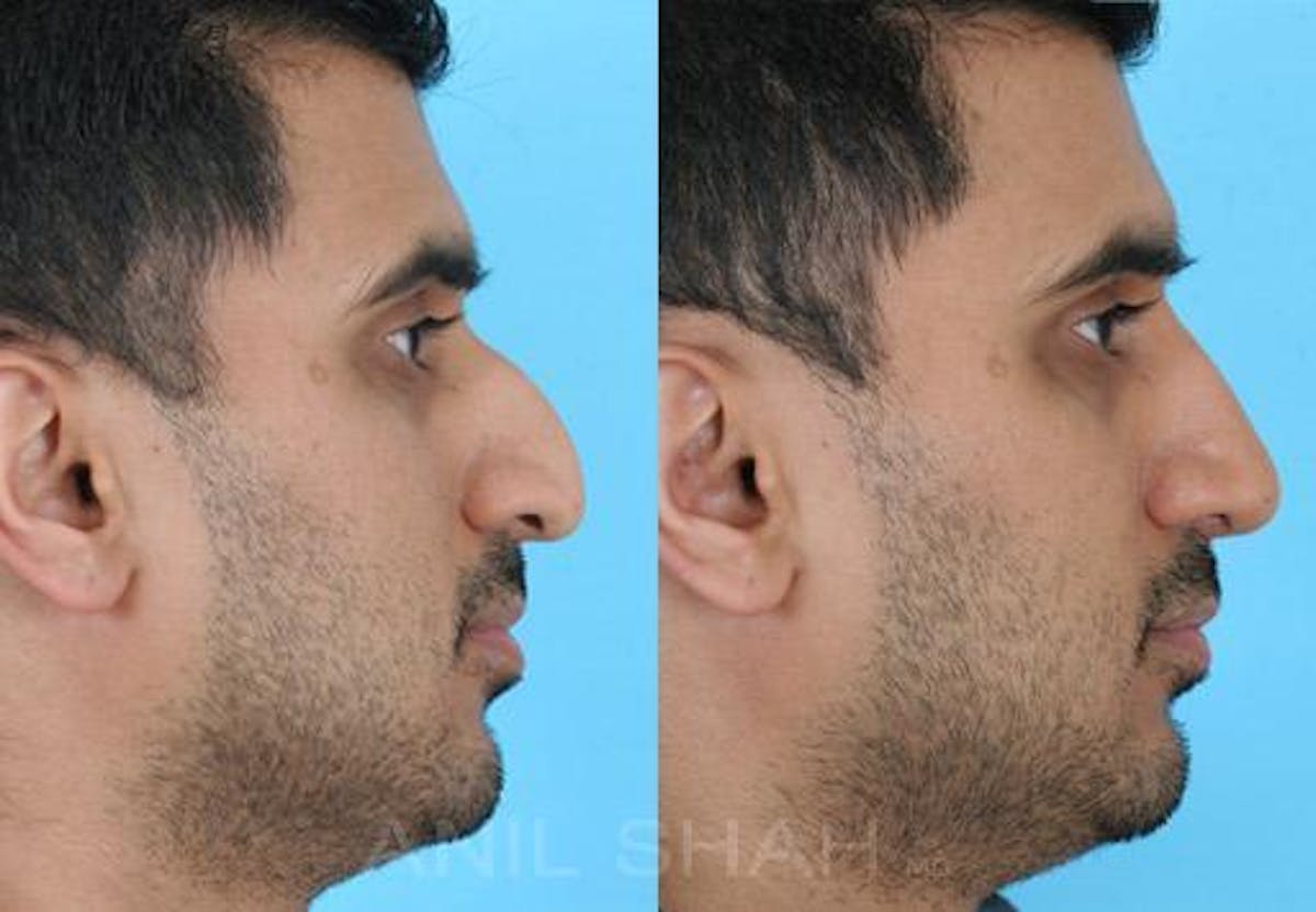 Rhinoplasty Before & After Gallery - Patient 299538 - Image 2