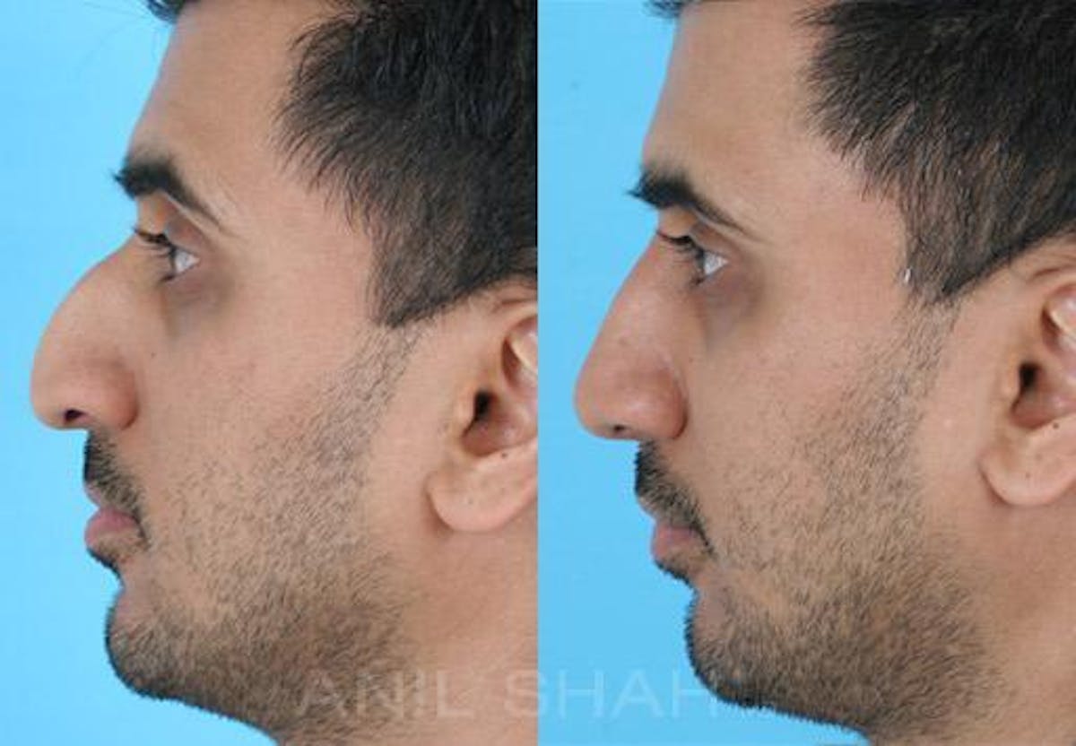 Rhinoplasty Before & After Gallery - Patient 299538 - Image 3