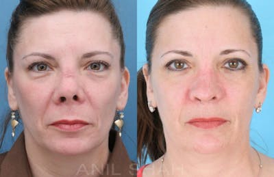 Rhinoplasty Before & After Gallery - Patient 364615 - Image 1