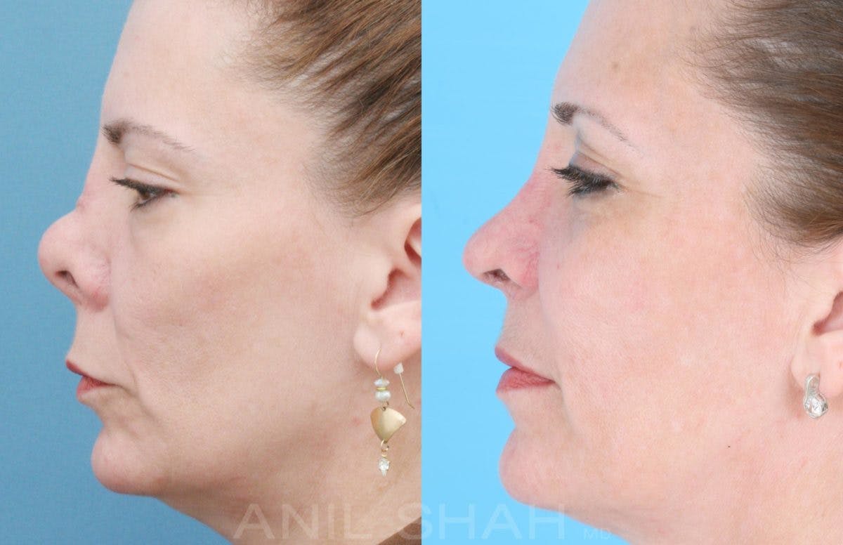 Rhinoplasty Before & After Gallery - Patient 364615 - Image 2