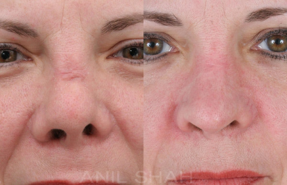 Rhinoplasty Before & After Gallery - Patient 364615 - Image 3