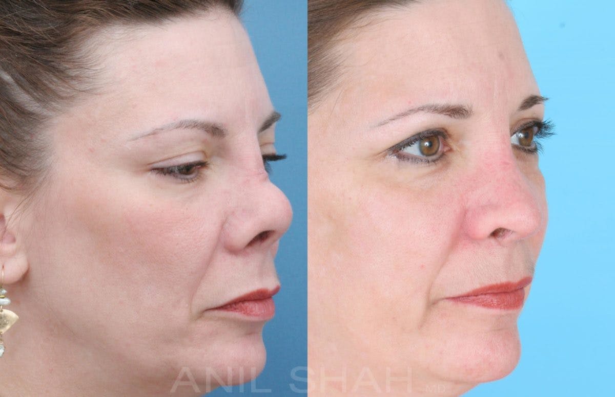 Rhinoplasty Before & After Gallery - Patient 364615 - Image 4