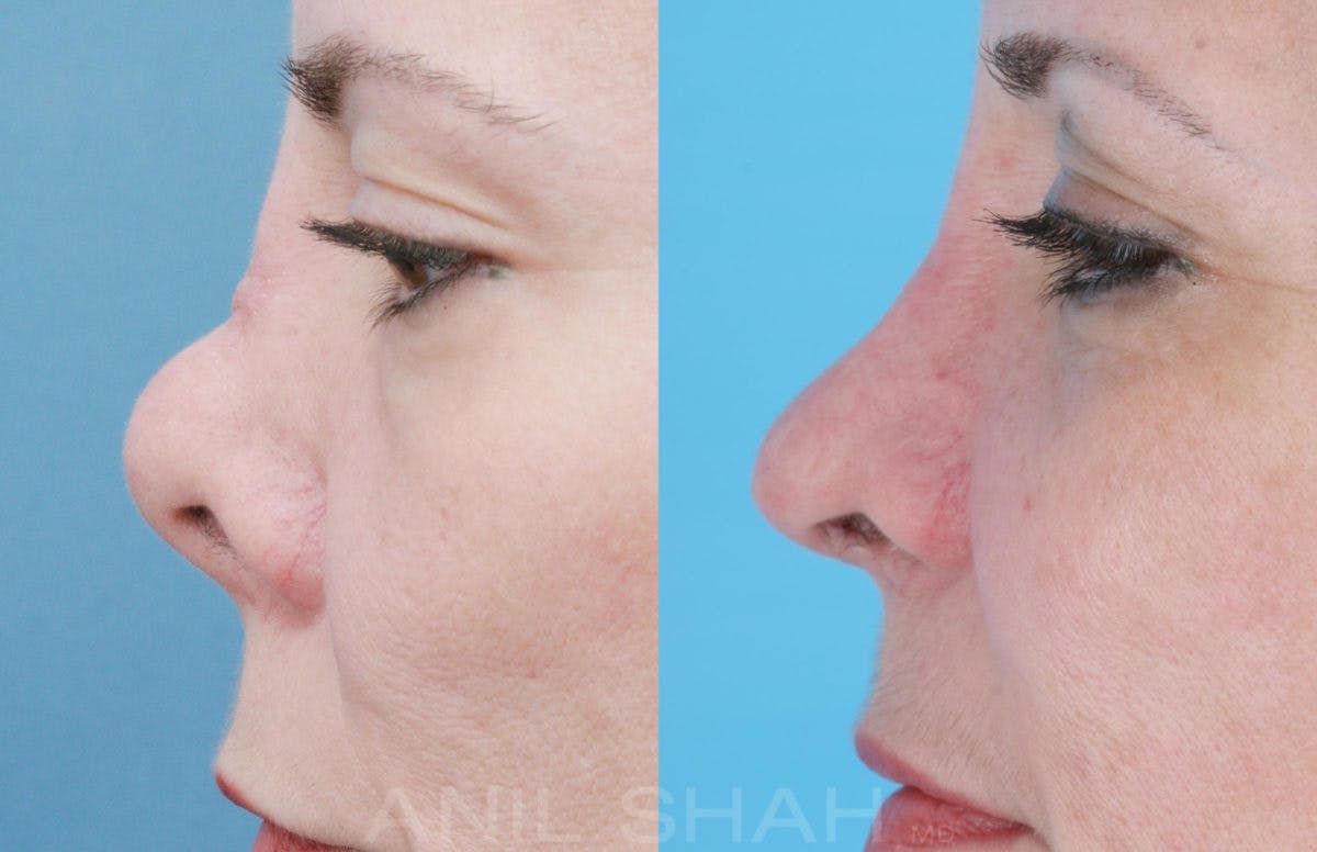 Rhinoplasty Before & After Gallery - Patient 364615 - Image 5