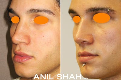 Rhinoplasty Before & After Gallery - Patient 408765 - Image 1