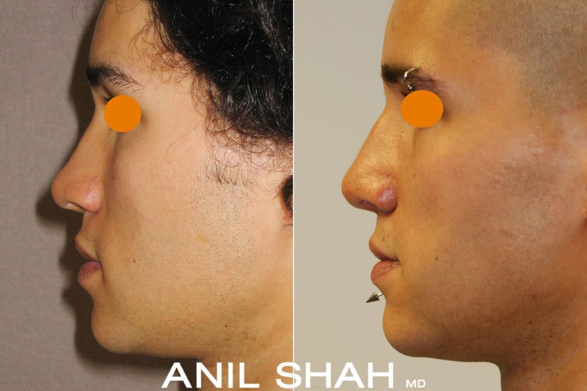 Rhinoplasty Before & After Gallery - Patient 408765 - Image 2