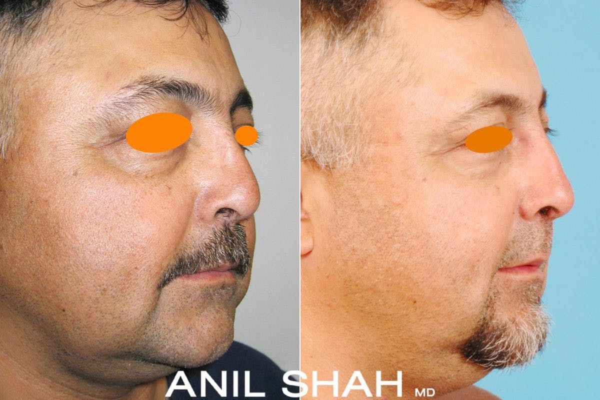 Rhinoplasty Before & After Gallery - Patient 120256 - Image 2