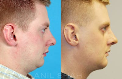 Rhinoplasty Before & After Gallery - Patient 198449 - Image 1