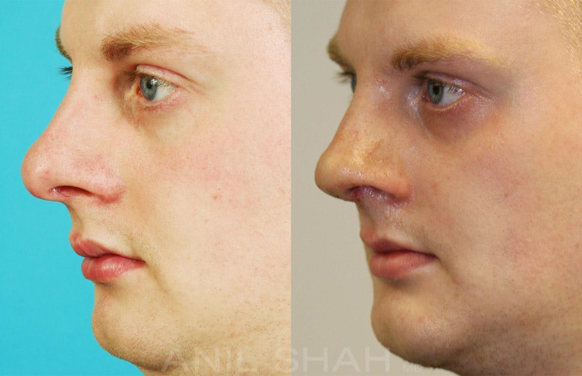 Rhinoplasty Before & After Gallery - Patient 198449 - Image 2