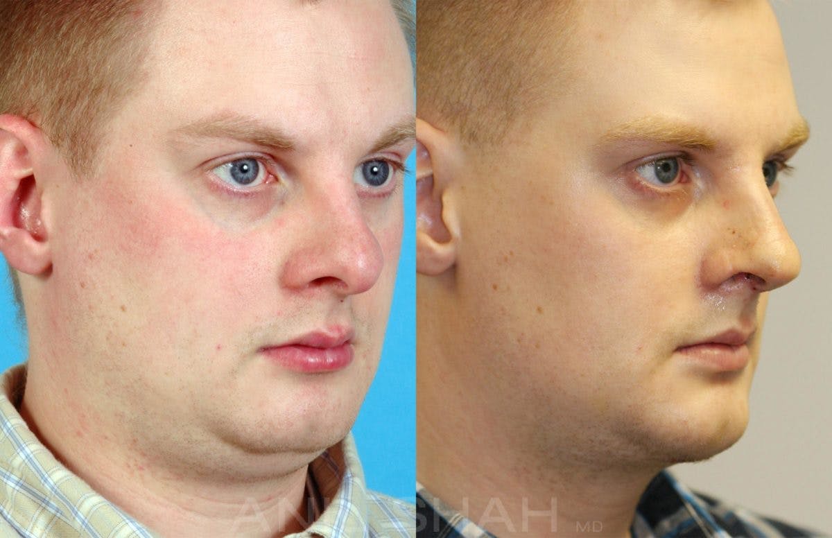 Rhinoplasty Before & After Gallery - Patient 198449 - Image 3
