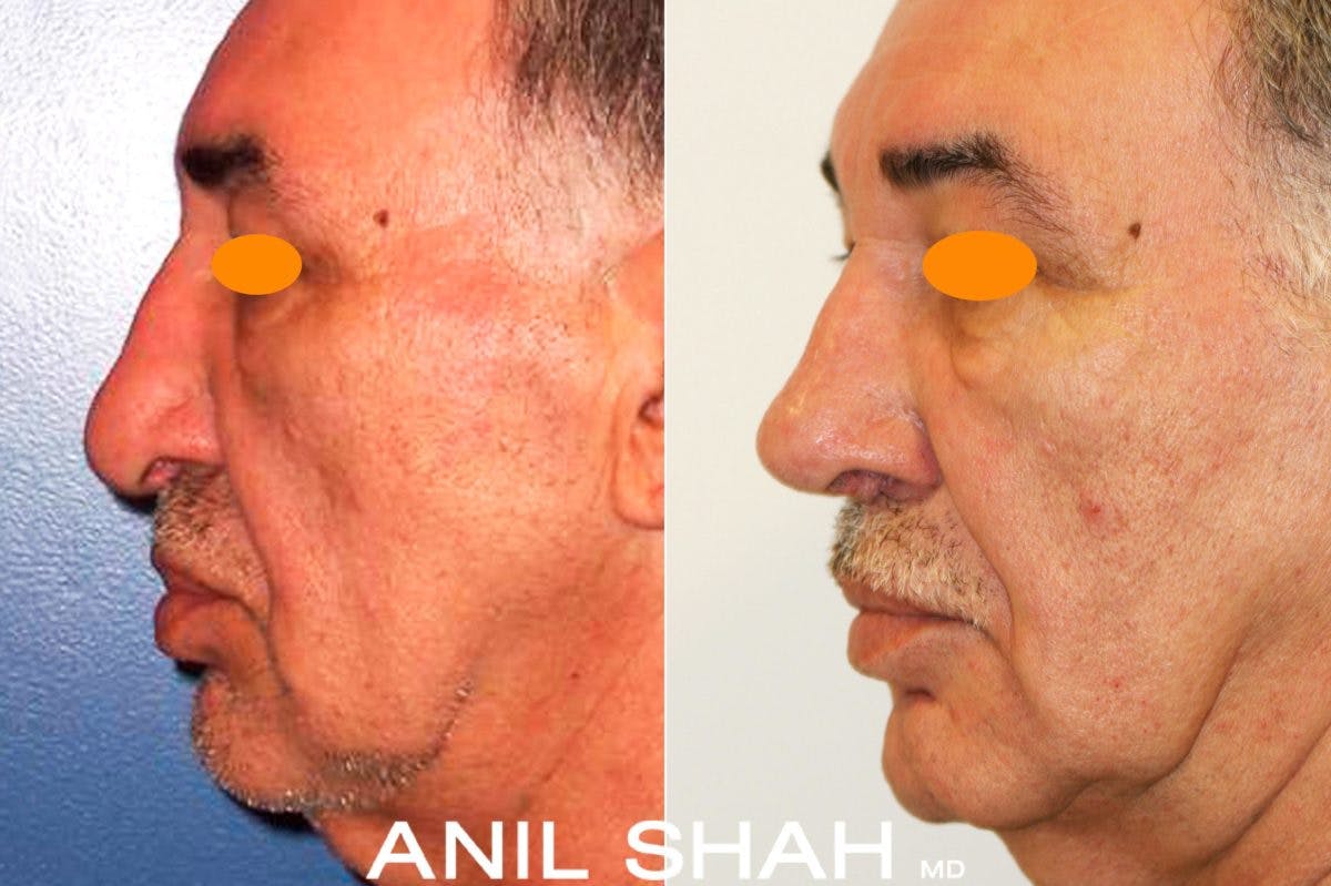 Rhinoplasty Before & After Gallery - Patient 668500 - Image 2