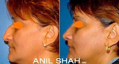 Rhinoplasty Before & After Gallery - Patient 169970 - Image 1