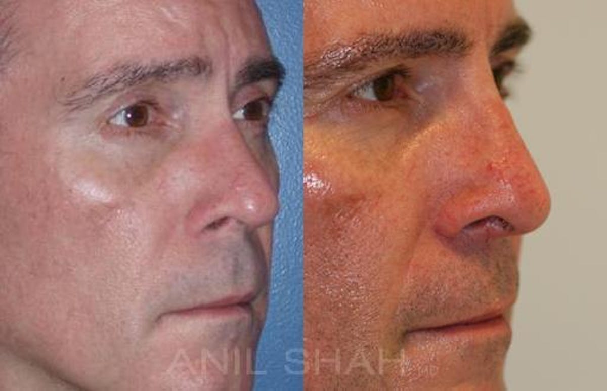 Rhinoplasty Before & After Gallery - Patient 373703 - Image 1