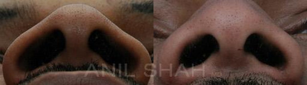 Rhinoplasty Before & After Gallery - Patient 191820 - Image 2