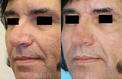 Rhinoplasty Before & After Gallery - Patient 620758 - Image 1