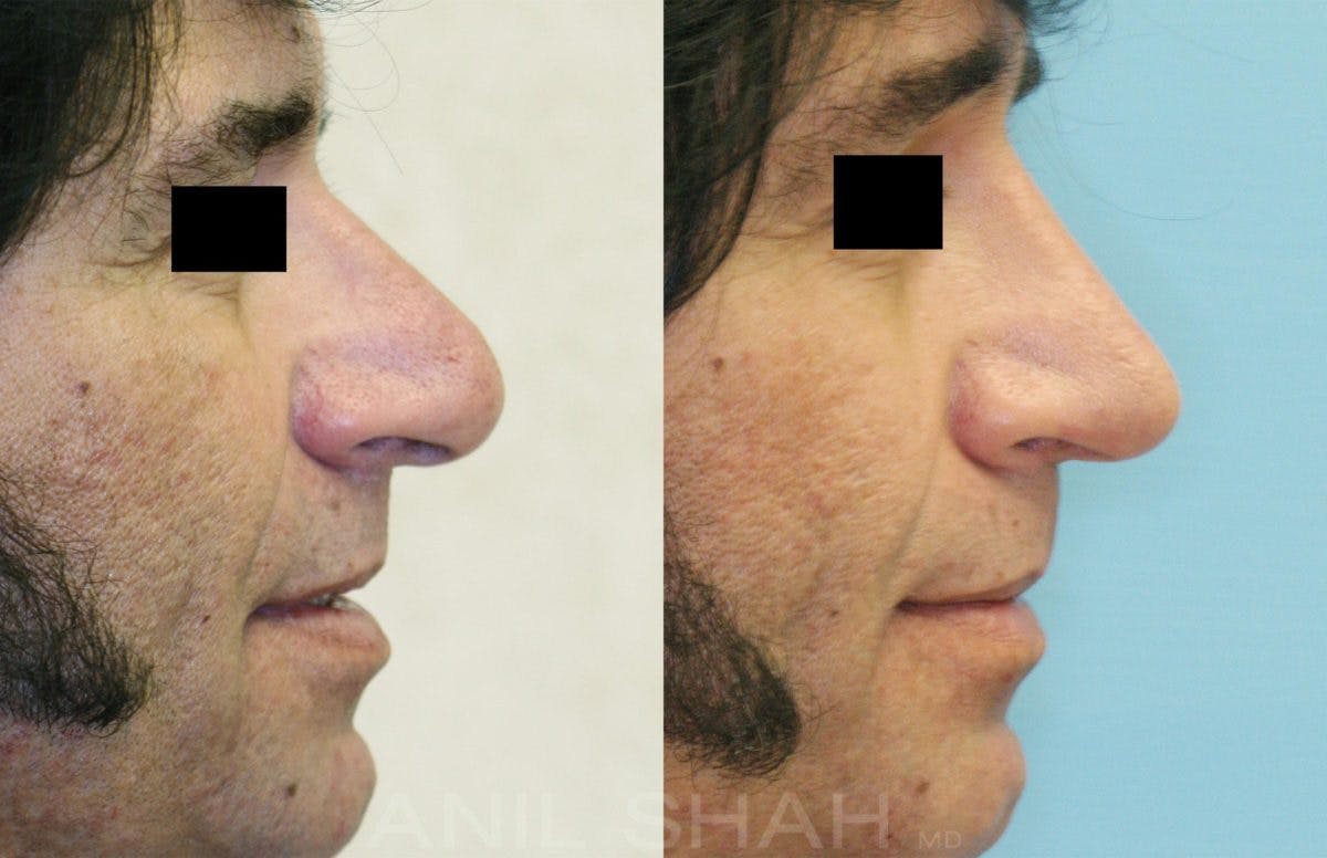Rhinoplasty Before & After Gallery - Patient 620758 - Image 2
