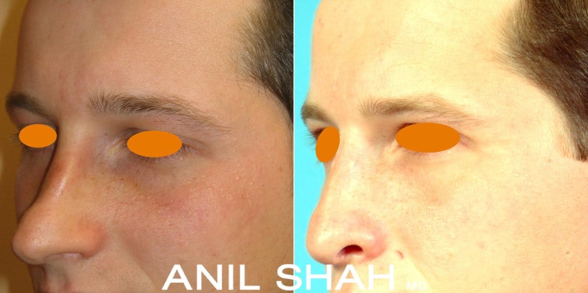 Rhinoplasty Before & After Gallery - Patient 246178 - Image 2