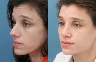 Rhinoplasty Before & After Gallery - Patient 287127 - Image 1