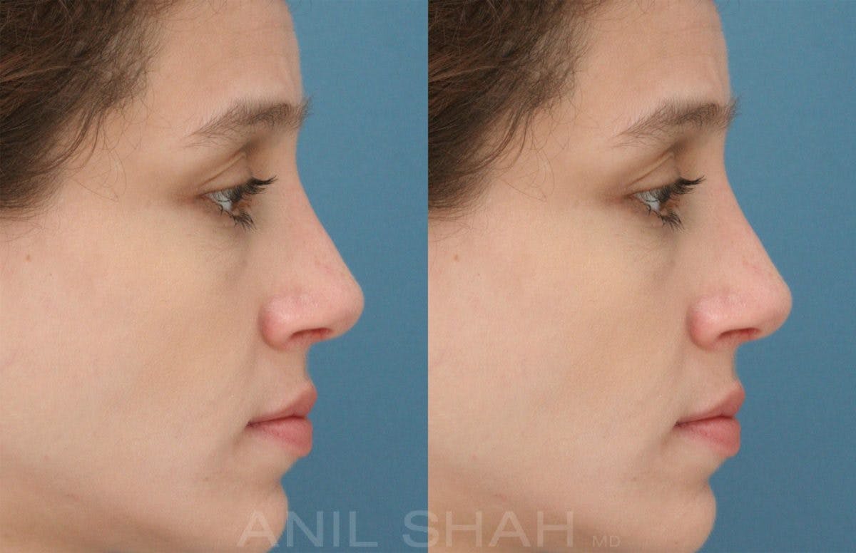 Rhinoplasty Before & After Gallery - Patient 287127 - Image 2