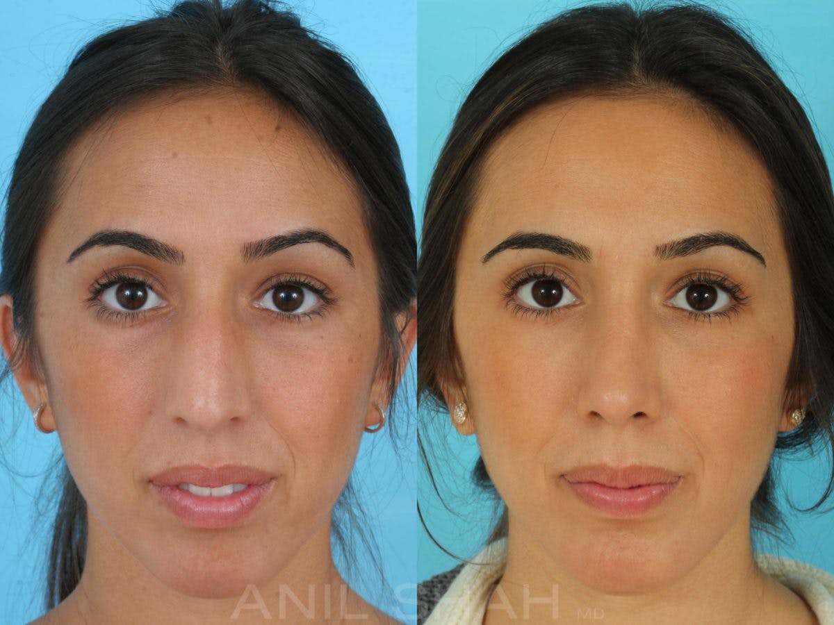 Rhinoplasty Before & After Gallery - Patient 137527 - Image 1