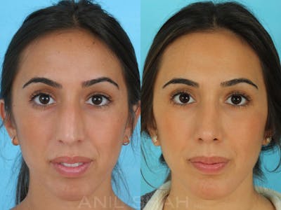Rhinoplasty Before & After Gallery - Patient 137527 - Image 1
