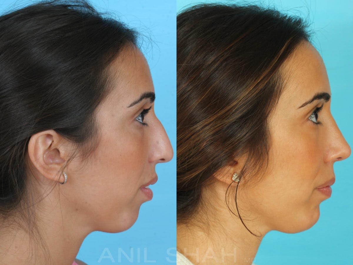 Rhinoplasty Before & After Gallery - Patient 137527 - Image 2
