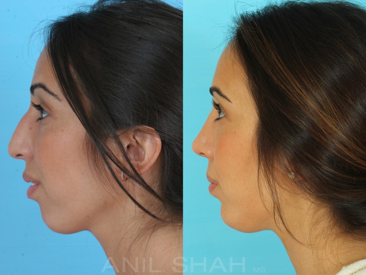 Rhinoplasty Before & After Gallery - Patient 137527 - Image 3
