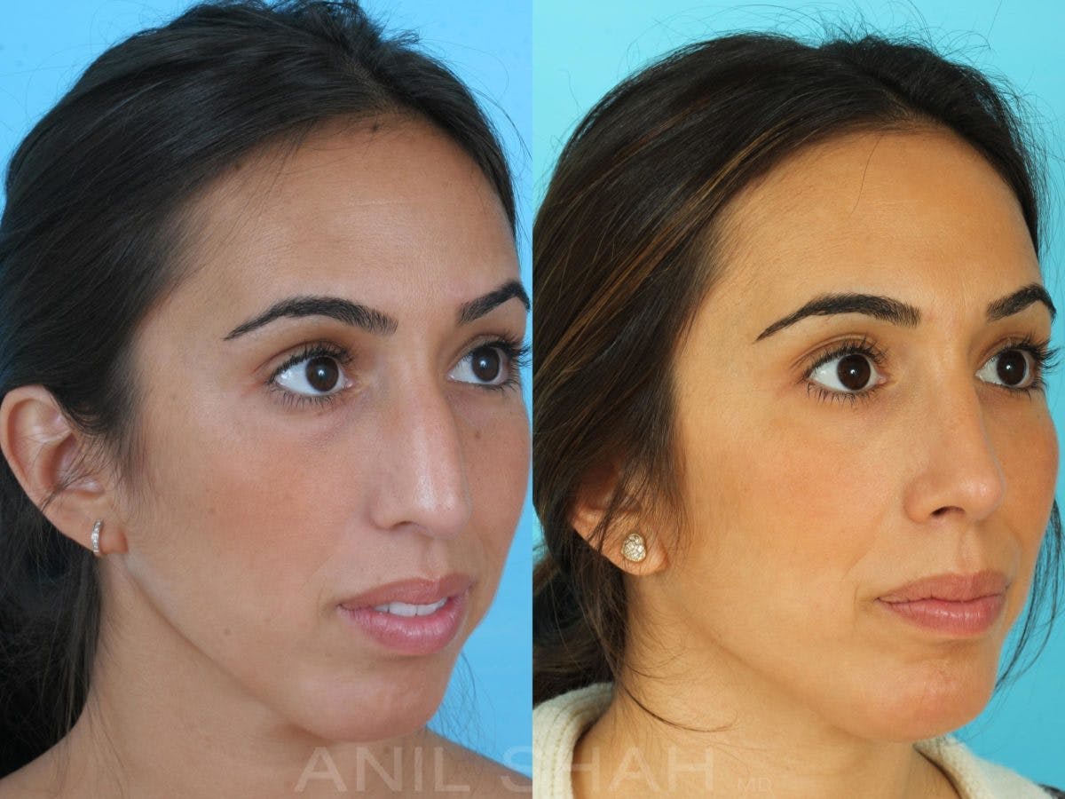 Rhinoplasty Before & After Gallery - Patient 137527 - Image 4