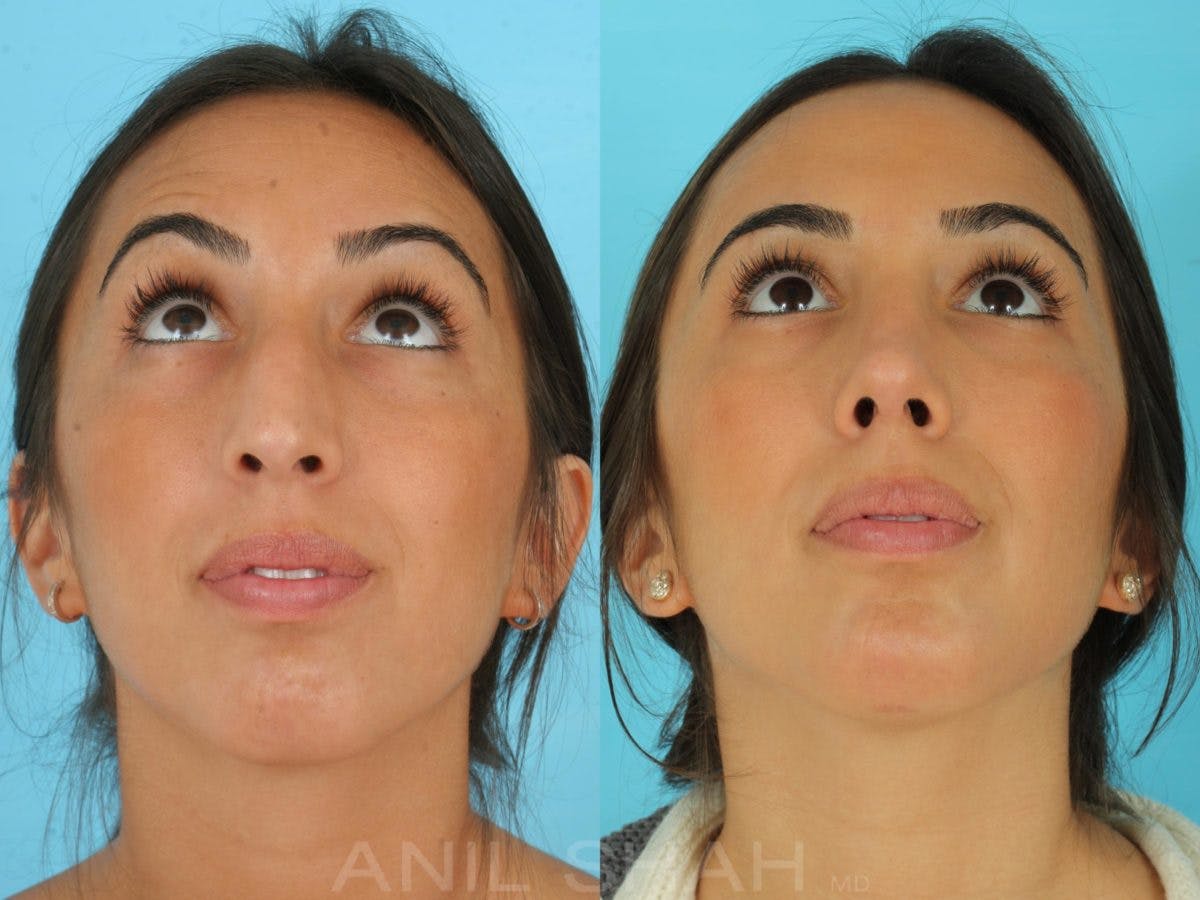 Rhinoplasty Before & After Gallery - Patient 137527 - Image 5