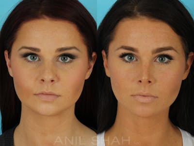 Rhinoplasty Before & After Gallery - Patient 270695 - Image 1