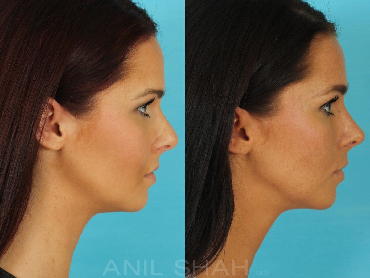 Rhinoplasty Before & After Gallery - Patient 270695 - Image 2