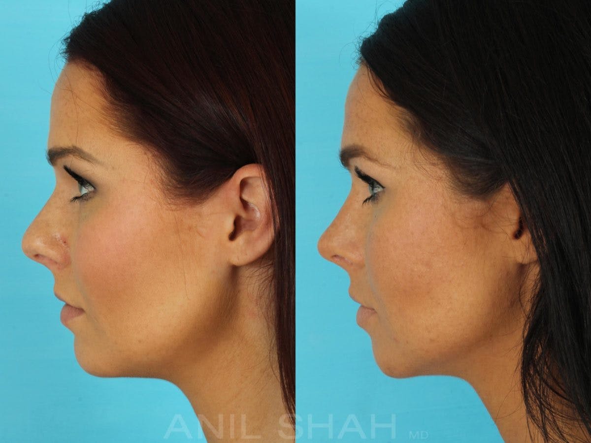 Rhinoplasty Before & After Gallery - Patient 270695 - Image 3