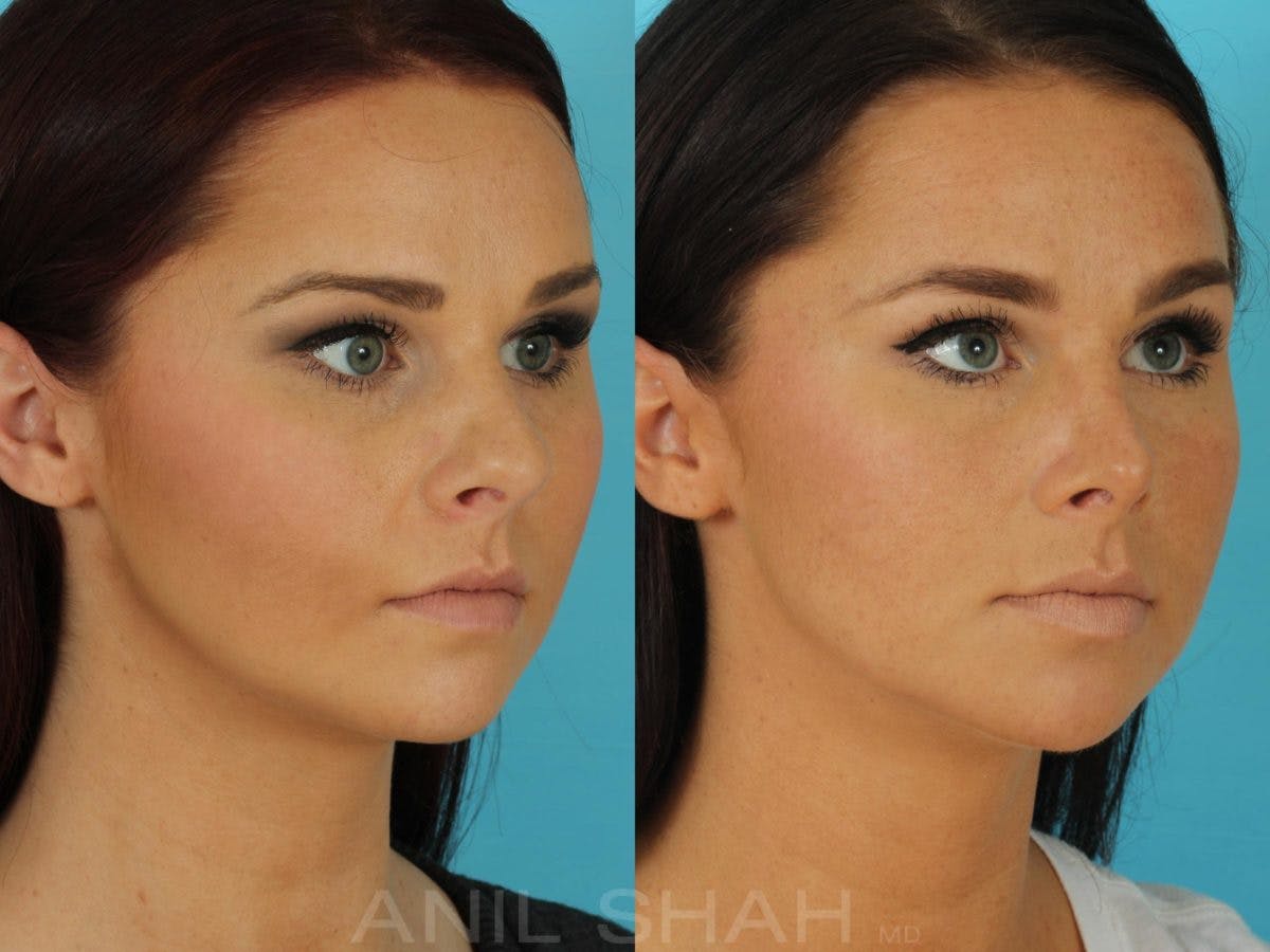 Rhinoplasty Before & After Gallery - Patient 270695 - Image 4
