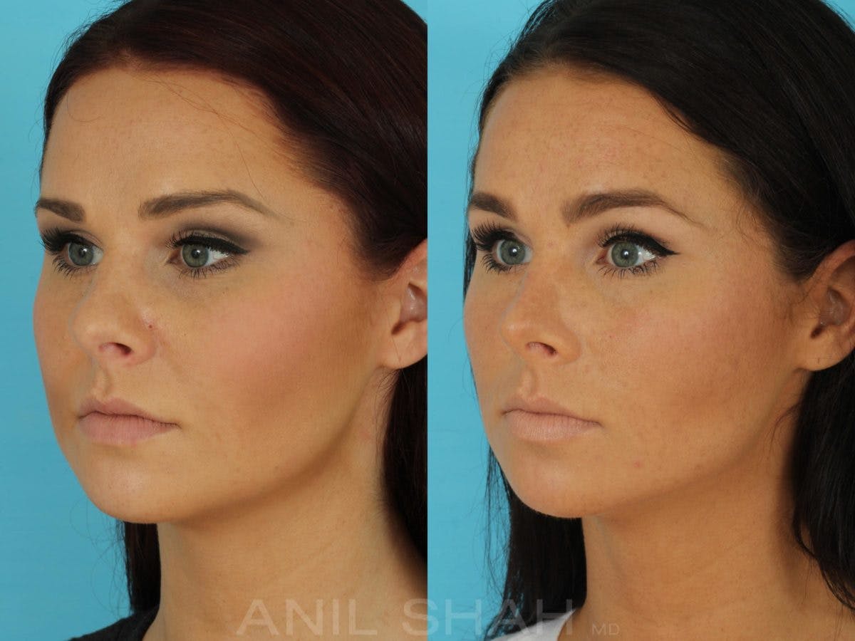 Rhinoplasty Before & After Gallery - Patient 270695 - Image 5