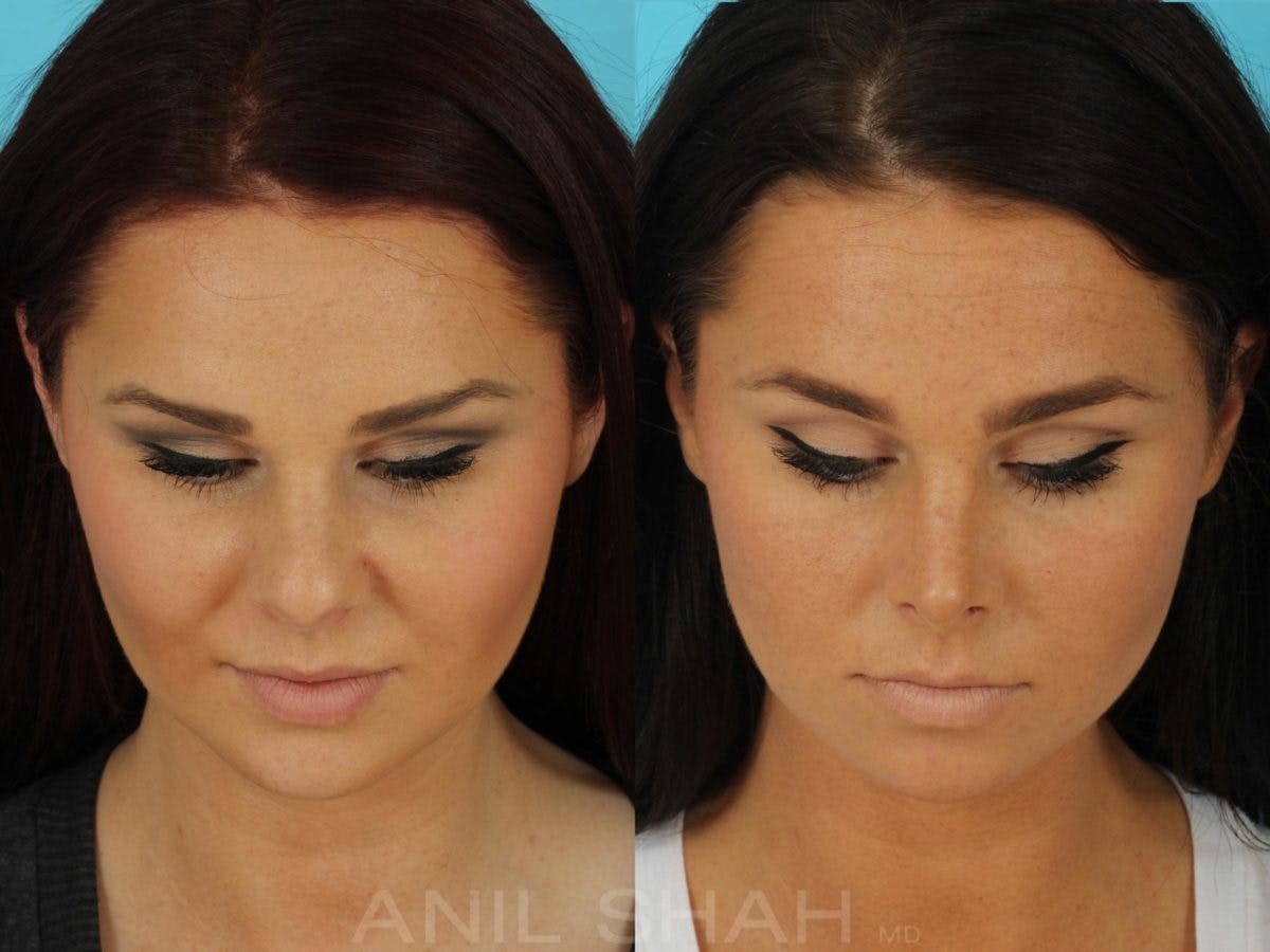 Rhinoplasty Before & After Gallery - Patient 270695 - Image 6