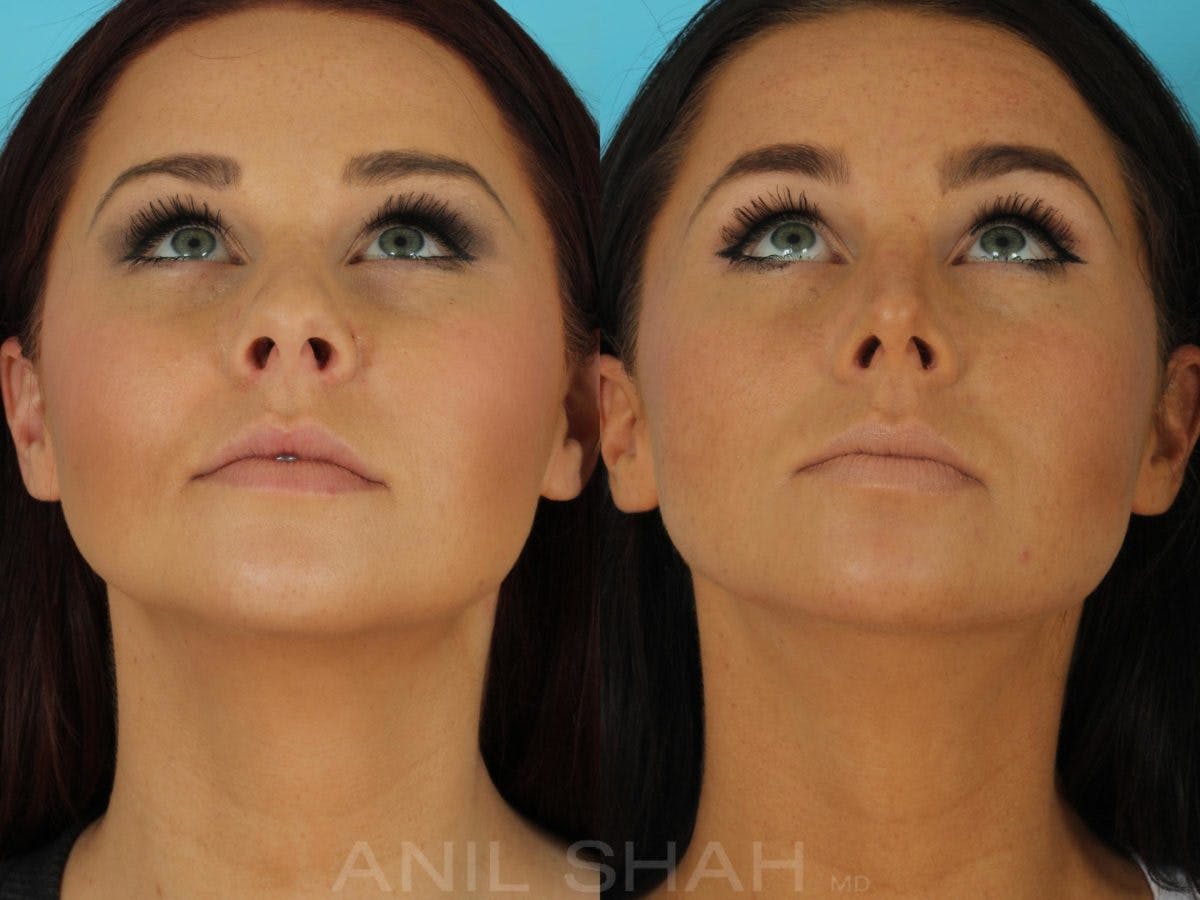 Rhinoplasty Before & After Gallery - Patient 270695 - Image 7