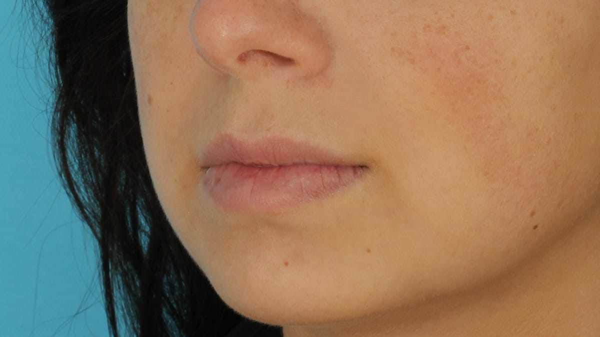 lip augmentation patient