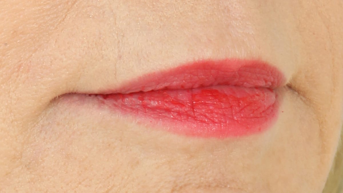 Lip Augmentation Chicago, IL Lip Injections Dr. Anil Shah