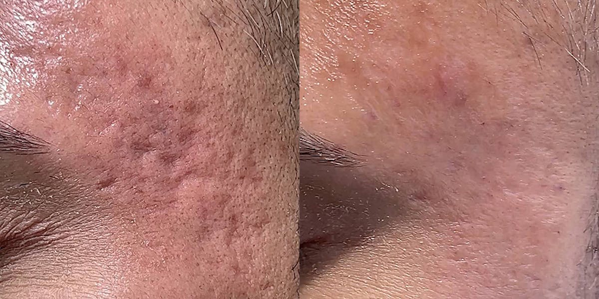 Acne Scars Before & After Gallery - Patient 238380 - Image 1