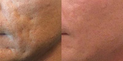 Acne Scars Before & After Gallery - Patient 169066 - Image 1