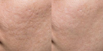 Acne Scars Before & After Gallery - Patient 139279 - Image 1