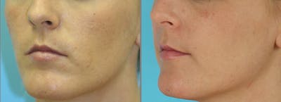Acne Scars Before & After Gallery - Patient 224364 - Image 1