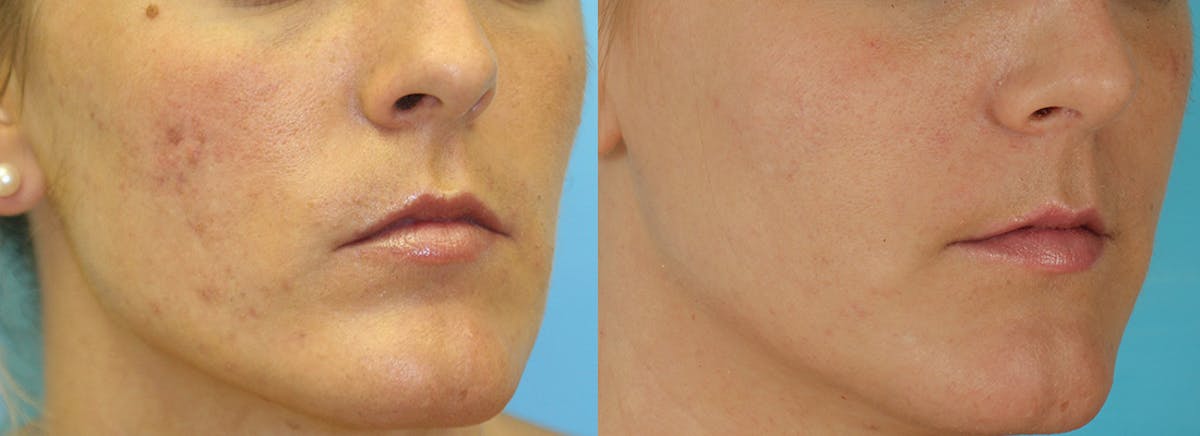 Acne Scars Before & After Gallery - Patient 224364 - Image 2