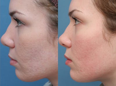 Acne Scars Before & After Gallery - Patient 343740 - Image 1