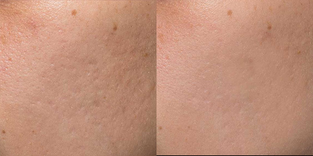 Acne Scars Before & After Gallery - Patient 138676 - Image 1
