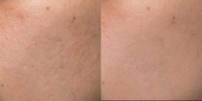 Acne Scars Before & After Gallery - Patient 138676 - Image 1