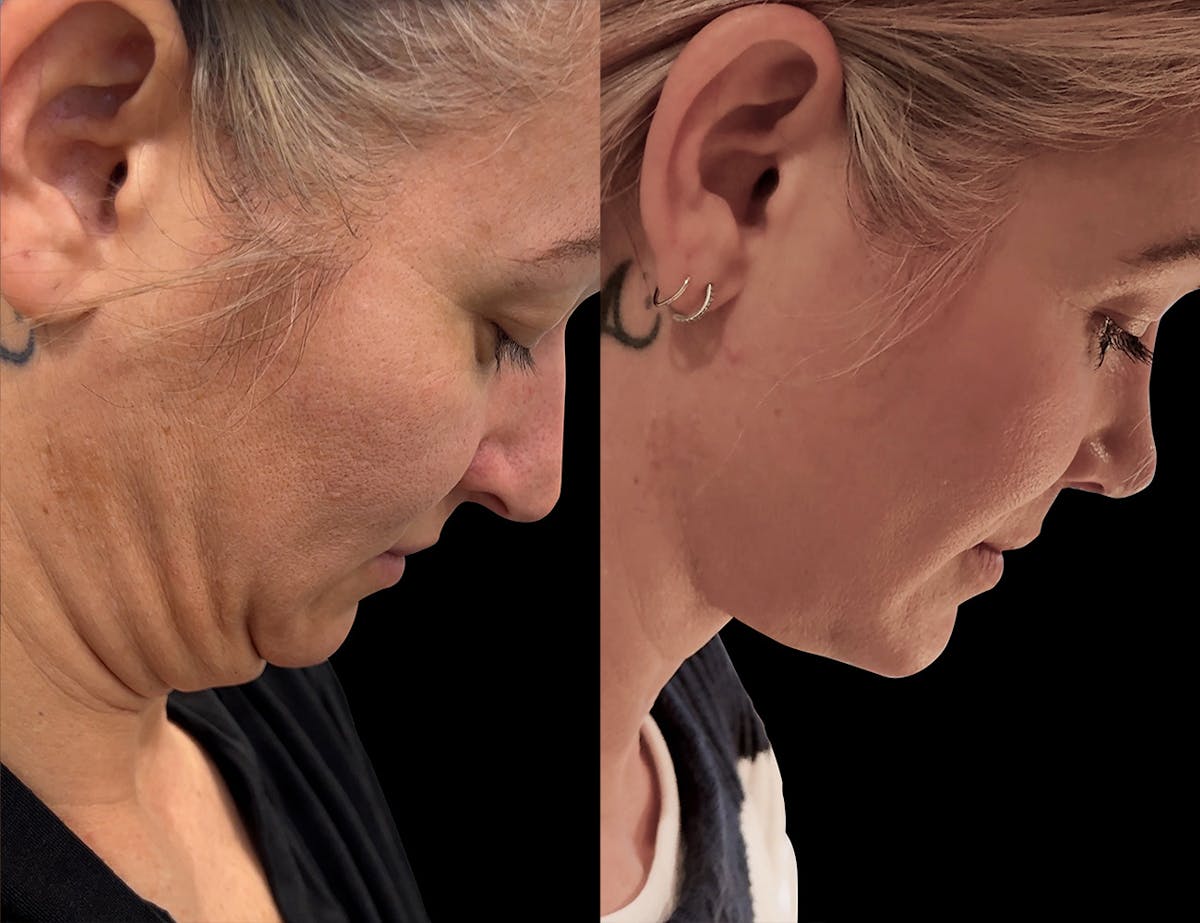 Aging Face Before & After Gallery - Patient 679982 - Image 3