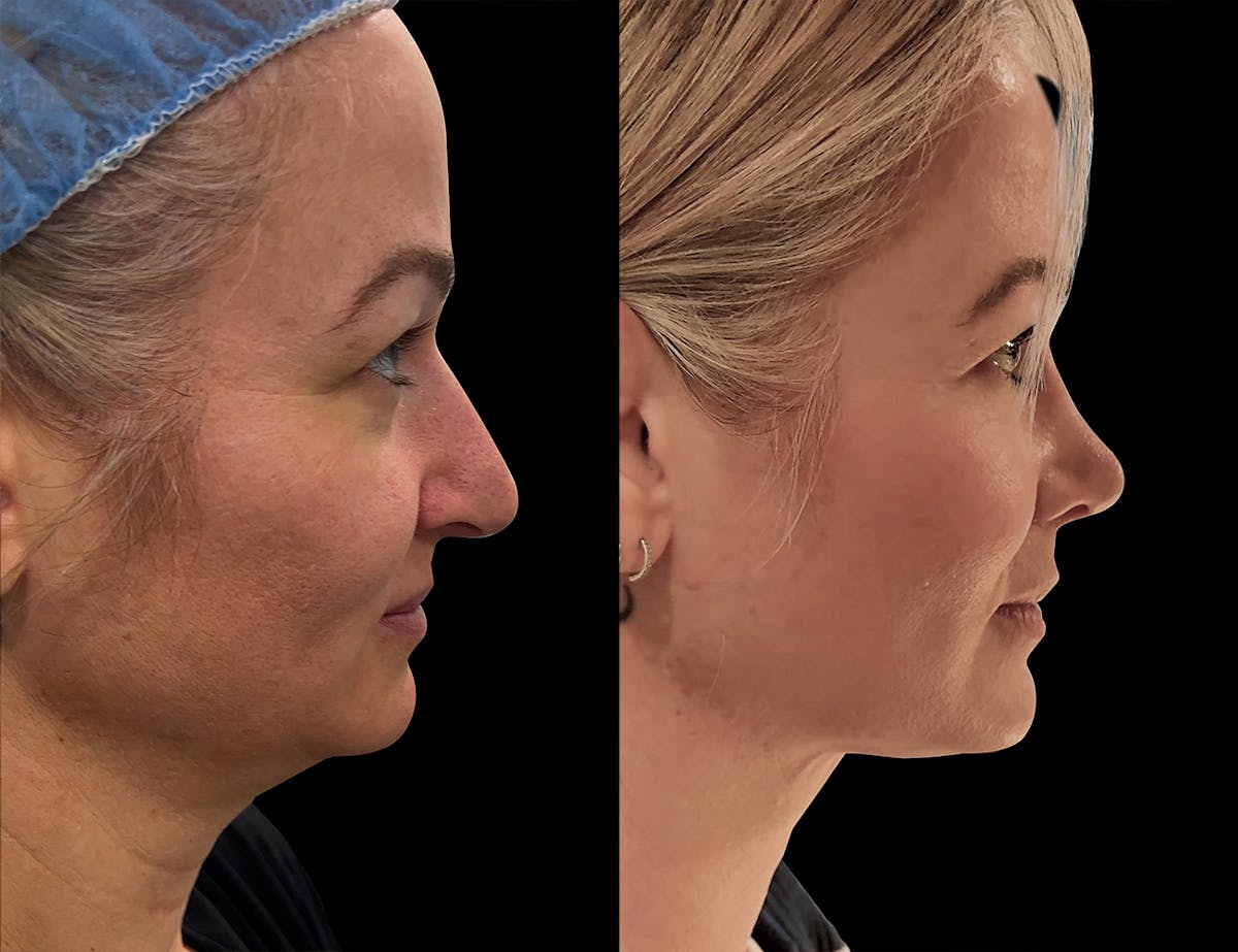 Aging Face Before & After Gallery - Patient 679982 - Image 2