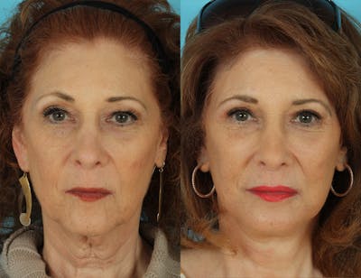 Aging Face Before & After Gallery - Patient 302535 - Image 1