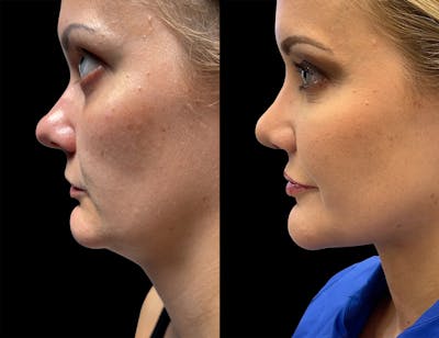 Aging Face Before & After Gallery - Patient 339753 - Image 1