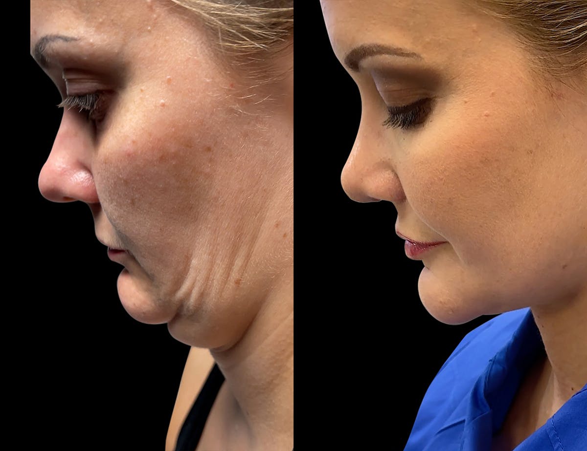Aging Face Before & After Gallery - Patient 339753 - Image 2